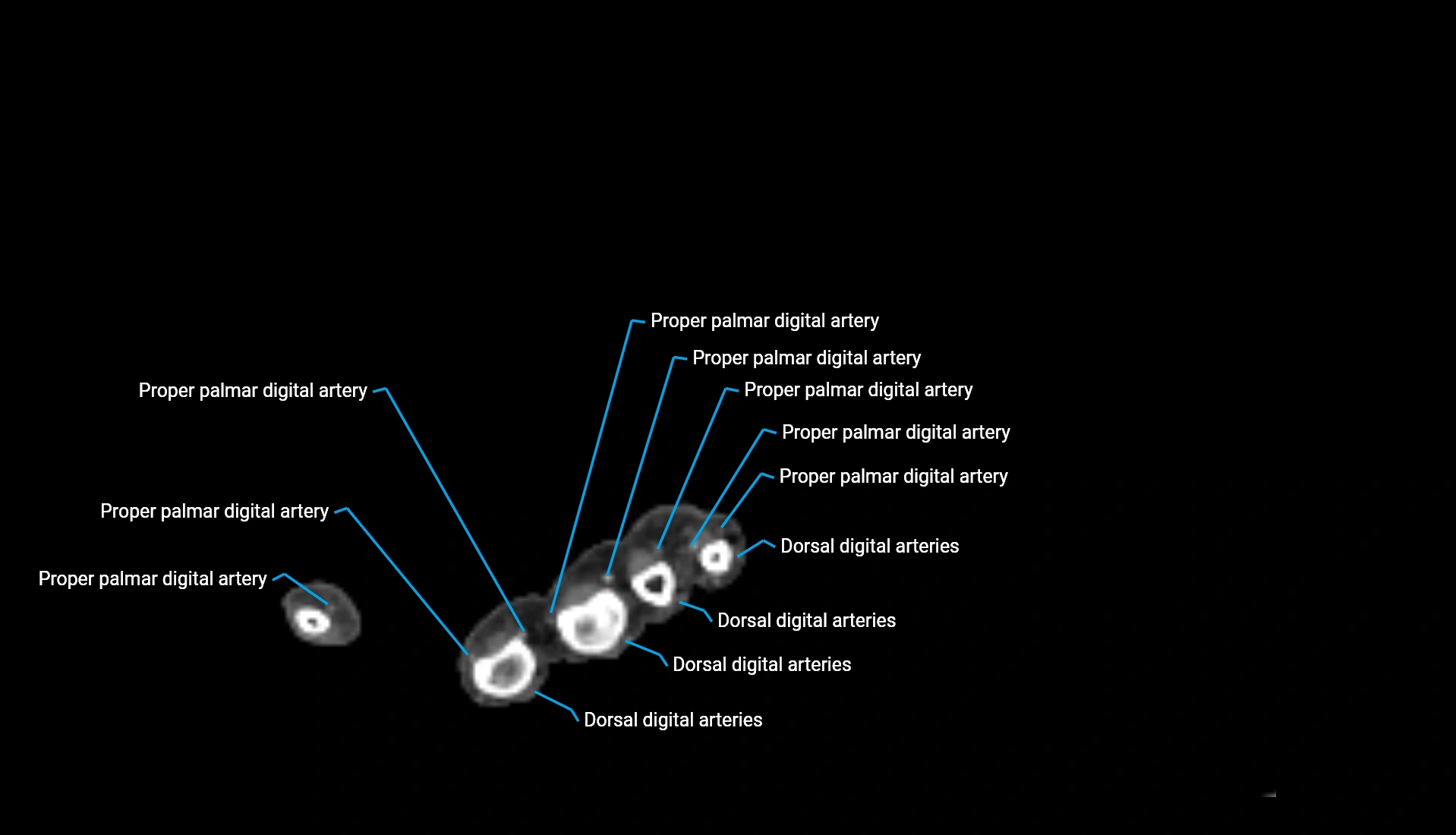 CTA upper limb axial cross sectional anatomy labelled image 41 (2).webp